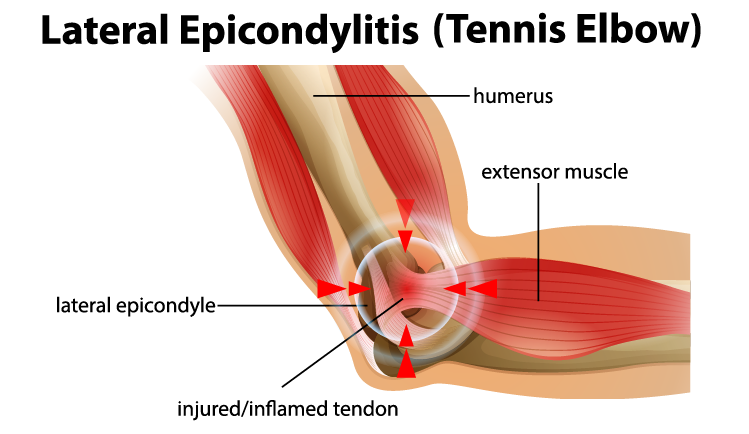 Anatomical illustration of the elbow joint, showing muscles and tendons involved in Lateral Epicondylitis or tennis elbow