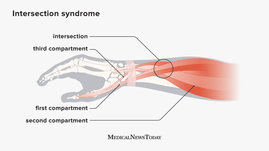 Intersection Syndrome anatomy, showing tendons and muscles involved in the condition.