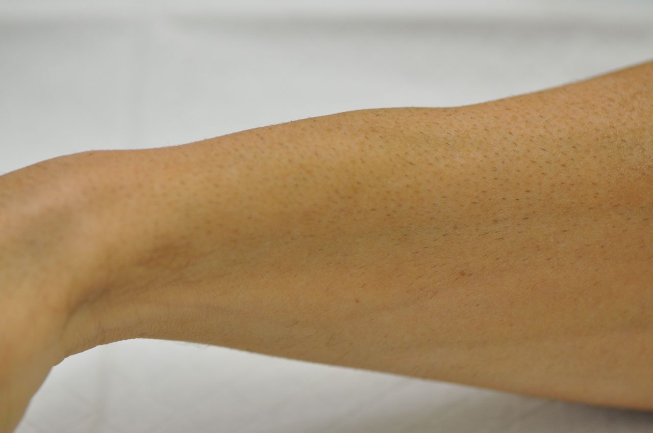 Forearm image, showing swelling of first compartment muscles, intersection syndrome